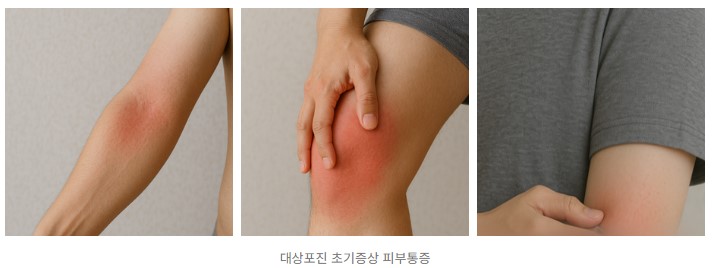 면역력 저하 대상포진 증상