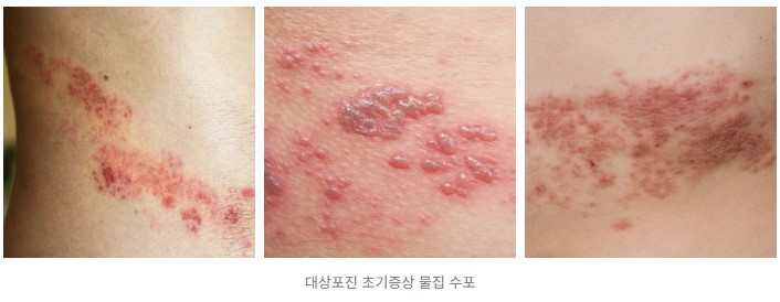 면역력 저하 대상포진 증상